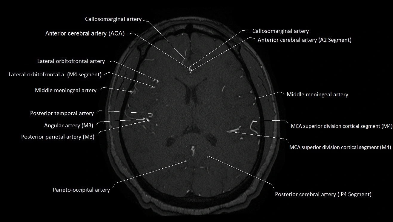 MRA brain (cerebral arteries) anatomy axial 3T image 33.webp